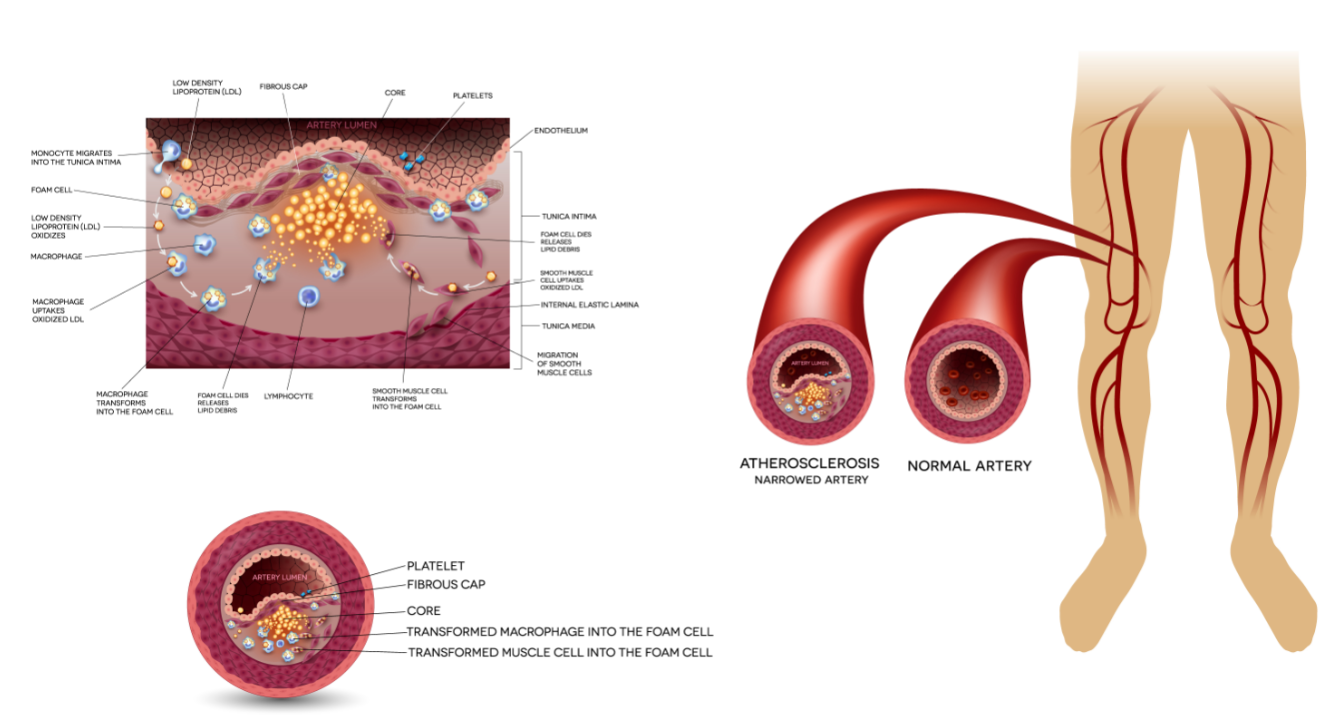 North Mississippi Vascular Care | Peripheral Arterial Disease Management